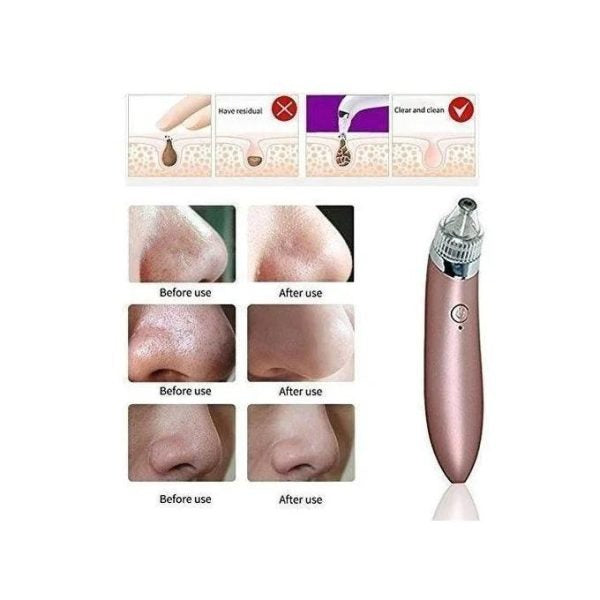 Professional Blackhead Removal Tool – Pore Vacuum for Nose & Face