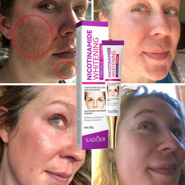 Nicotinamide Whitening Freckles Cream – Melasma & Dark Spot Removal
